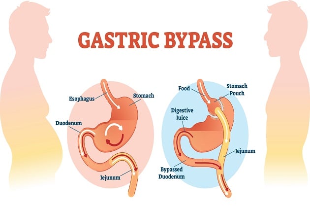 <p>reducing the size of the stomach and bypassing parts of the small intestine to limit food intake and nutrient absorption</p>