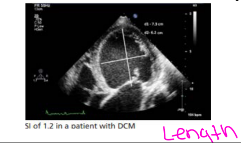 <p>To evaluate the shape of the LV</p><p>• Calculation of the ratio between ED length and width</p><p>• Predictor of survival in DCM patients</p>