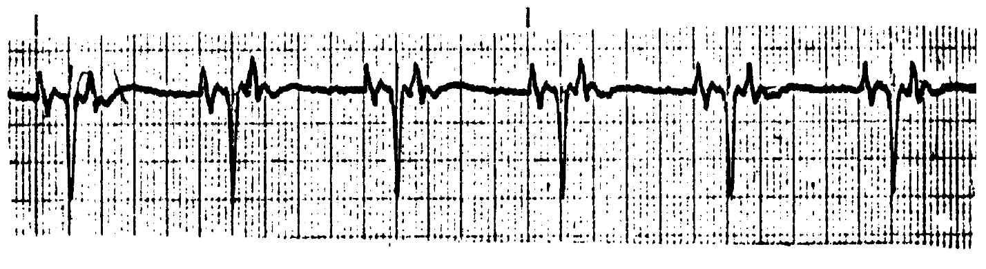<p>What ECG is this? </p>
