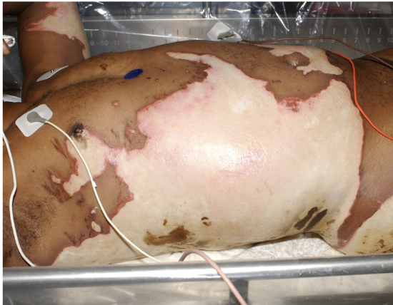 <p>aka 3rd degree </p><ul><li><p>destruction of <strong>ENTIRE epidermis AND dermis </strong></p></li><li><p>little to no cap refill </p></li><li><p>thrombosed blood vessels (essentially cauterized) may be visible </p></li><li><p>surface firm, <strong>dry</strong>, leathery </p></li><li><p>NO pain or sensation </p></li><li><p>does not heal on its own — will require skin grafting </p></li></ul><p></p>