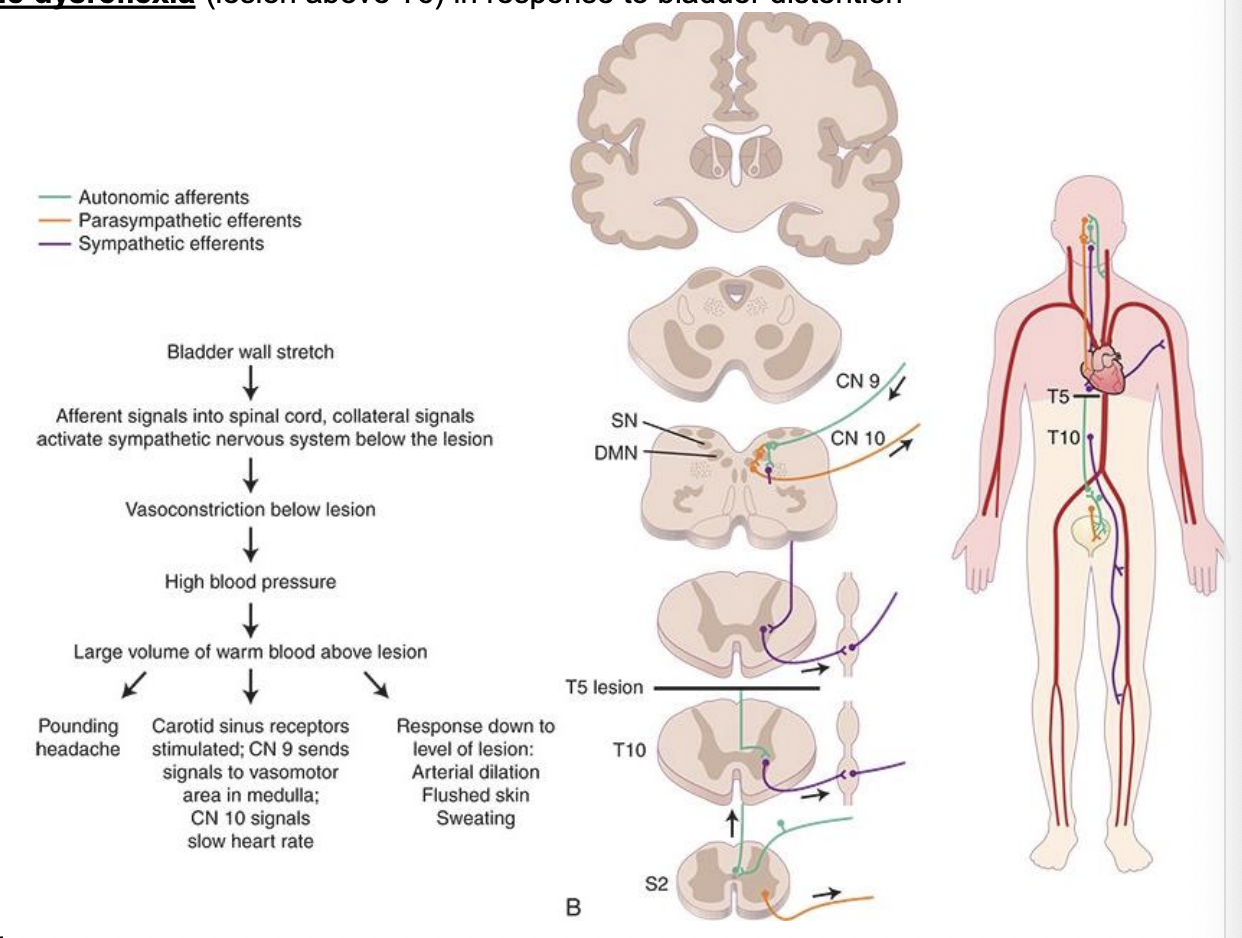 <ul><li><p>sudden over-active autonomic nervous system </p><ul><li><p>potentially life threatening (medical emergency) </p></li><li><p>can result in stroke, heart attack, seizures, death </p></li></ul></li></ul><ul><li><p>who is at risk for autonomic dysreflexia? </p><ul><li><p>people with SC injury at T6 or above is most common cause </p></li><li><p>other factors: </p><ul><li><p>brain injury, stroke, multiple sclerosis, Guillain-Barre syndrome, side effects of medication </p></li></ul></li></ul></li><li><p>triggers: irritation, noxious stimuli (painful or not) </p><ul><li><p>bladder — over-distention, kink in a catheter, bladder spasms, infection </p></li><li><p>bowel — constipation, hemorrhoids, gas, diarrhea </p></li><li><p>skin — constrictive clothing (jeans, socks, shoes), bed sores, ingrown toenails, cuts, bruises </p></li></ul></li><li><p>results in uncoordinated autonomic responses </p></li></ul><p></p>