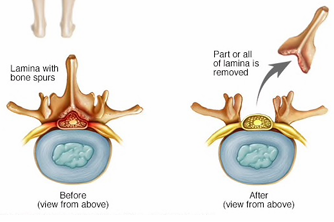 <p>Removal of the lamina to enlarge the spinal canal to relieve pressure on the spinal cord or nerves</p><p><u>Indication</u>: Spinal stenosis or radiculopathy</p><p><u>Contraindications</u>: Instability</p><p><u>Post Operation</u>: Indep mobility, indep ADLs, limited lifting, 70-80% positive outcomes</p><p>Complications: Spondylolistheses </p>