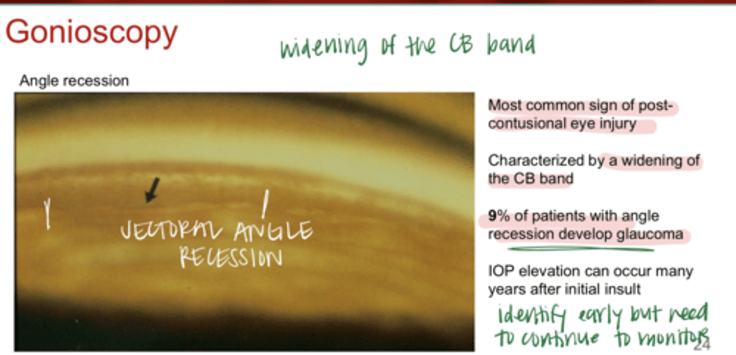 <p>True or False: </p><p>IOP elevation can occur many years after the initial insult causing angle recession</p>