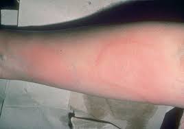 <p>superficial, raised, transient and erythematous, irregular shape from edema (mosquito bite, allergic rx)</p>