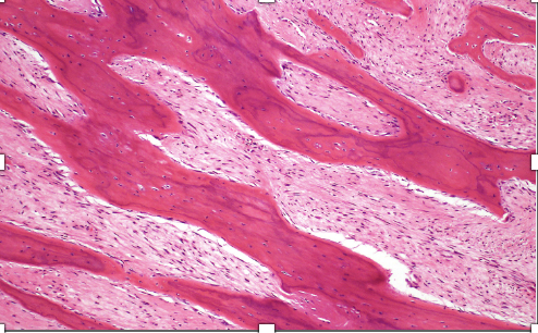<p>Masse intramédullaire osseuse métaphyse du tibia patient de 30 ans</p><p>diagnostic</p><p>définition</p><p>age</p><p>topographie</p><p>anatomie</p><p>histologie</p><p>ihc et moléculaire</p>