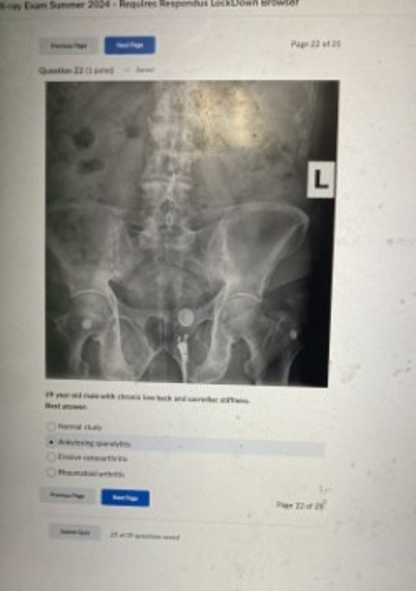<p>Ankylosing spondylitis</p>