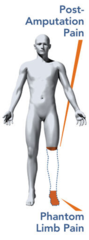 <p>patients who have had a limb amputated may still experience sensations such as itching, pressure, tingling, or pain as if the limb were still there</p>