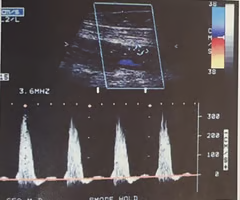 <p><span>IF the peak systolic velocity (PSV) in the region of stenosis is measured at 300 cm / sec, what would the prestenotic PSVs have to be for this stenosis to be considered >75% diameter reduction?<br><br>A. 150 cm / sec<br><br>B. 400 cm / sec<br><br>C. 75 cm / sec<br><br>D. 200 cm / sec</span></p>