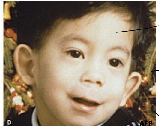 <p>fetal alcohol syndrome is an example of a ___ syndrome</p>