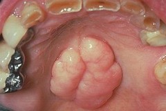 <p>None, unless it interferes with speech, swallowing, or a prosthetic appliance.</p>