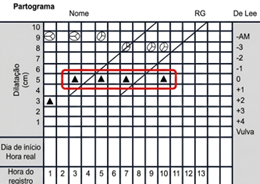 <p>Qual o diagnóstico do partograma, qual conduta?</p>
