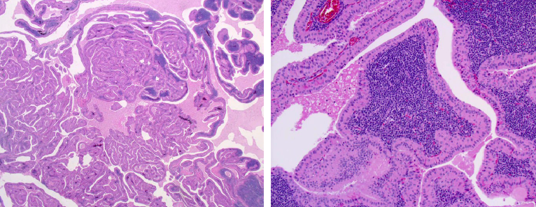 <p>warthin tumor histopathologic features</p>