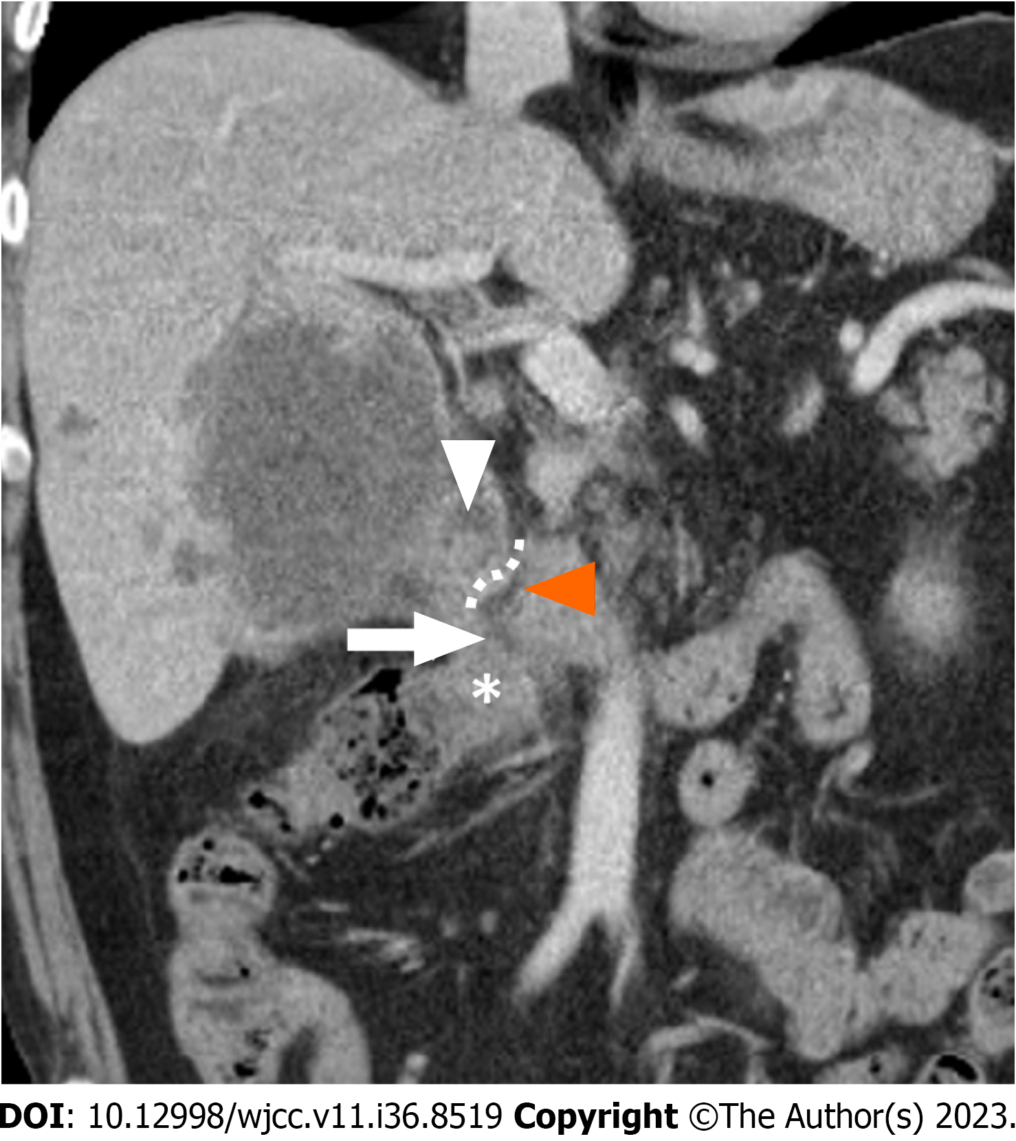 <p>Cholecystoenteric fistula. Here a pt with gallebladder cancer</p>