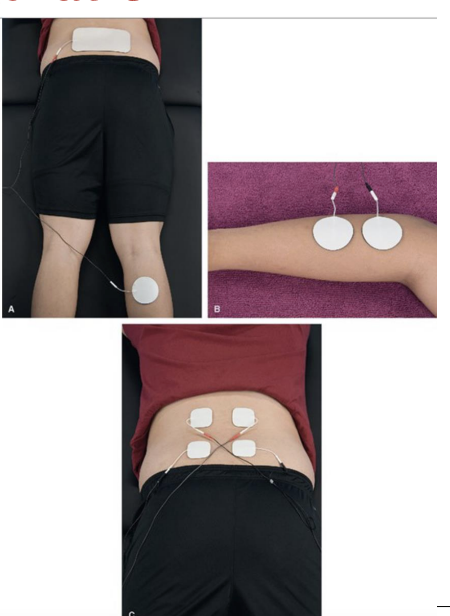 <p>four electrodes from two separate circuits, placed so currents are intentionally crossed over target tissues </p><ul><li><p>requires specific application of channels to achieve effect </p></li></ul><p></p>