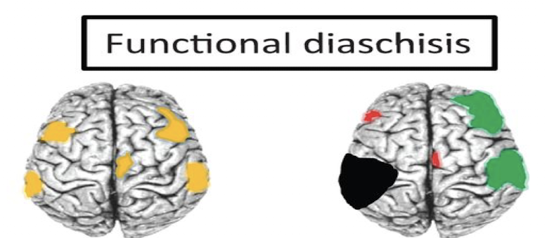<p>Functional diaschisis</p>