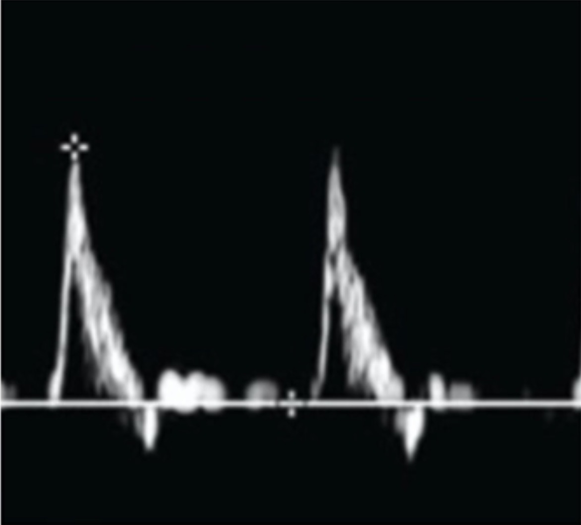 <p>If you saw this waveform in the common carotid artery, where would you expect to see the stenosis?</p>