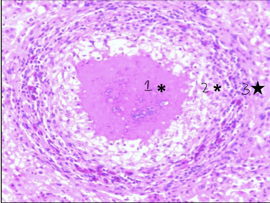 <p>List the parts of the granuloma created by caseous necrosis </p>