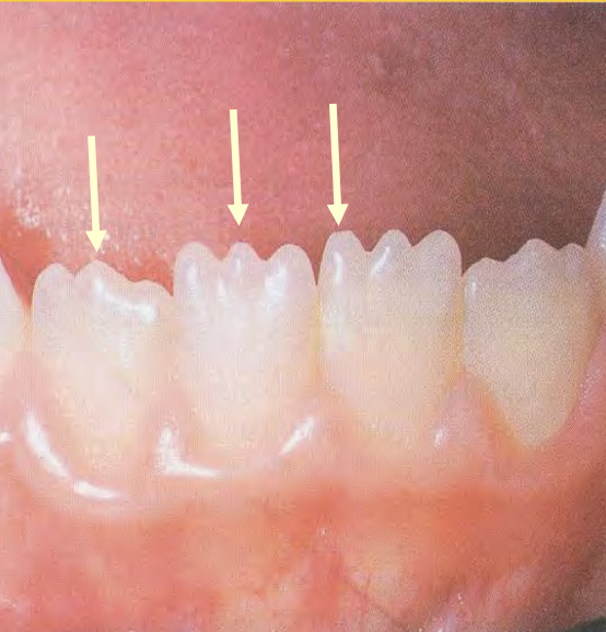 <p>What is the name of the indicated structure on the incisal ridge of the incisors?</p>