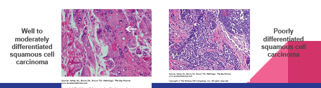 <p>The extent to which a neoplastic cell resembles a normal cell from which it arose.</p><ul><li><p>Classified as “<span style="color: red;">well differentiated</span>, <span style="color: red;">moderately differentiated</span>, <span style="color: red;">poorly differentiated</span>”</p></li></ul><p></p>