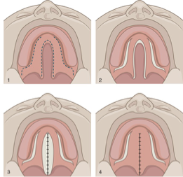 <p>What is this cleft palate repair technique?</p><p></p>