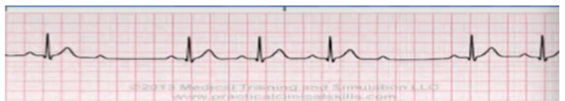 <ul><li><p><span style="background-color: transparent;">Mobitz 1/wenckebach</span></p></li><li><p><span style="background-color: transparent;">Irregular</span></p></li><li><p><span style="background-color: transparent;">More Ps than QRSs</span></p></li><li><p><span style="background-color: transparent;">PRI progressive lengthens then drops QRS</span></p></li><li><p><span style="background-color: transparent;">Heart rate: 60bpm</span></p></li><li><p><span style="background-color: transparent;">Rhythm: irregular</span></p></li><li><p><span style="background-color: transparent;">P waves: present, more than QRS</span></p></li><li><p><span style="background-color: transparent;">PR interval: progressively lengthens then drops QRS</span></p></li><li><p><span style="background-color: transparent;">QRS complex: narrow</span></p></li></ul><p></p>