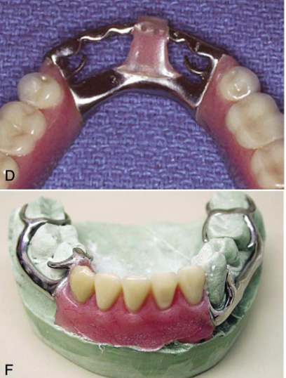 <p>Double lingual (Kennedy) bar</p>