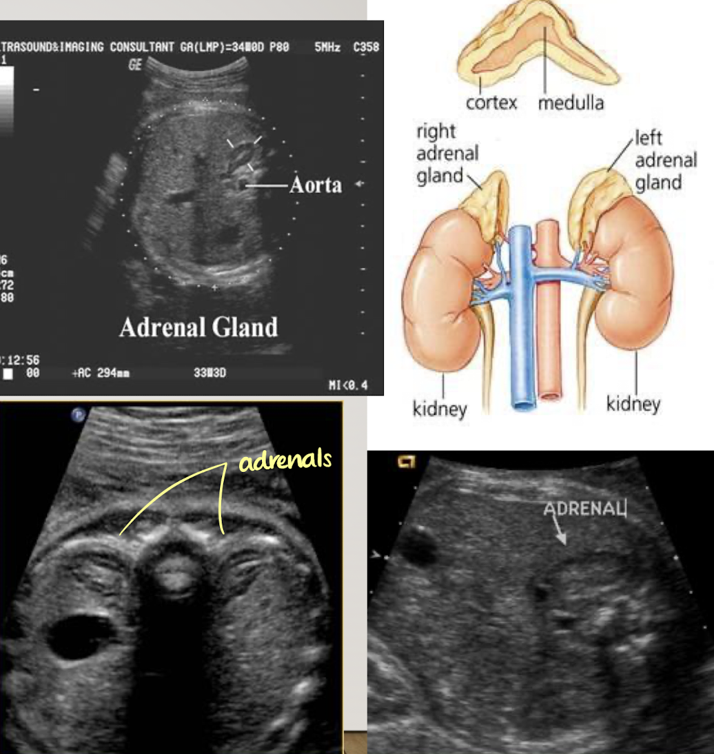 <ul><li><p>adrenal glands can be prominent in fetus and neonate</p></li><li><p>located medially and superior to fetal kidneys</p></li><li><p>SONO:</p><ul><li><p>best seen in TRV</p></li><li><p>superior pole of kidneys</p></li><li><p><span style="color: red;">hypoechoic cortex</span></p></li><li><p><span style="color: red;">echogenic medulla</span></p></li></ul></li></ul><p></p>