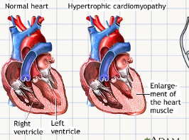 <p></p><p><span>A heart condition characterized by <strong>thickening</strong> and <strong>distortion</strong> of the<strong> mitral valve tissue</strong>, leading to heart enlargement and reduced function.</span></p>