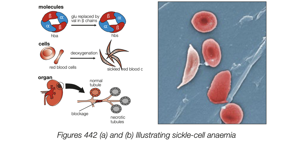 <ul><li><p>HbA and HbS exhibit form of co-dominance (or incomplete dominance) - heterzygous form exhibits features from both alleles (normal and abnormal haemoglobin made)</p></li><li><p>people with mutant gene and mutant heamoglobin dont have normal bi-concave TBC - become sickle-shaped</p><ul><li><p>often causes death in homoxygous individiuals </p></li></ul></li></ul><p></p>