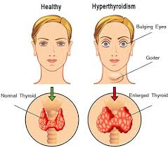 <p><span style="line-height: 107%;"><strong>BOOK:</strong></span></p><p class="MsoNormal"><span>Condition characterized by high blood levels of thyroid hormone.</span></p><p class="MsoNormal"><span style="line-height: 107%;"><strong>SIMPLE:</strong></span></p><p class="MsoNormal">A condition in which the <span style="font-family: Calibri, sans-serif;"><strong>thyroid gland produces too much thyroid hormone</strong></span>, speeding up the body’s metabolism.</p>