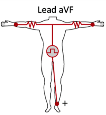 <p>aVF</p>