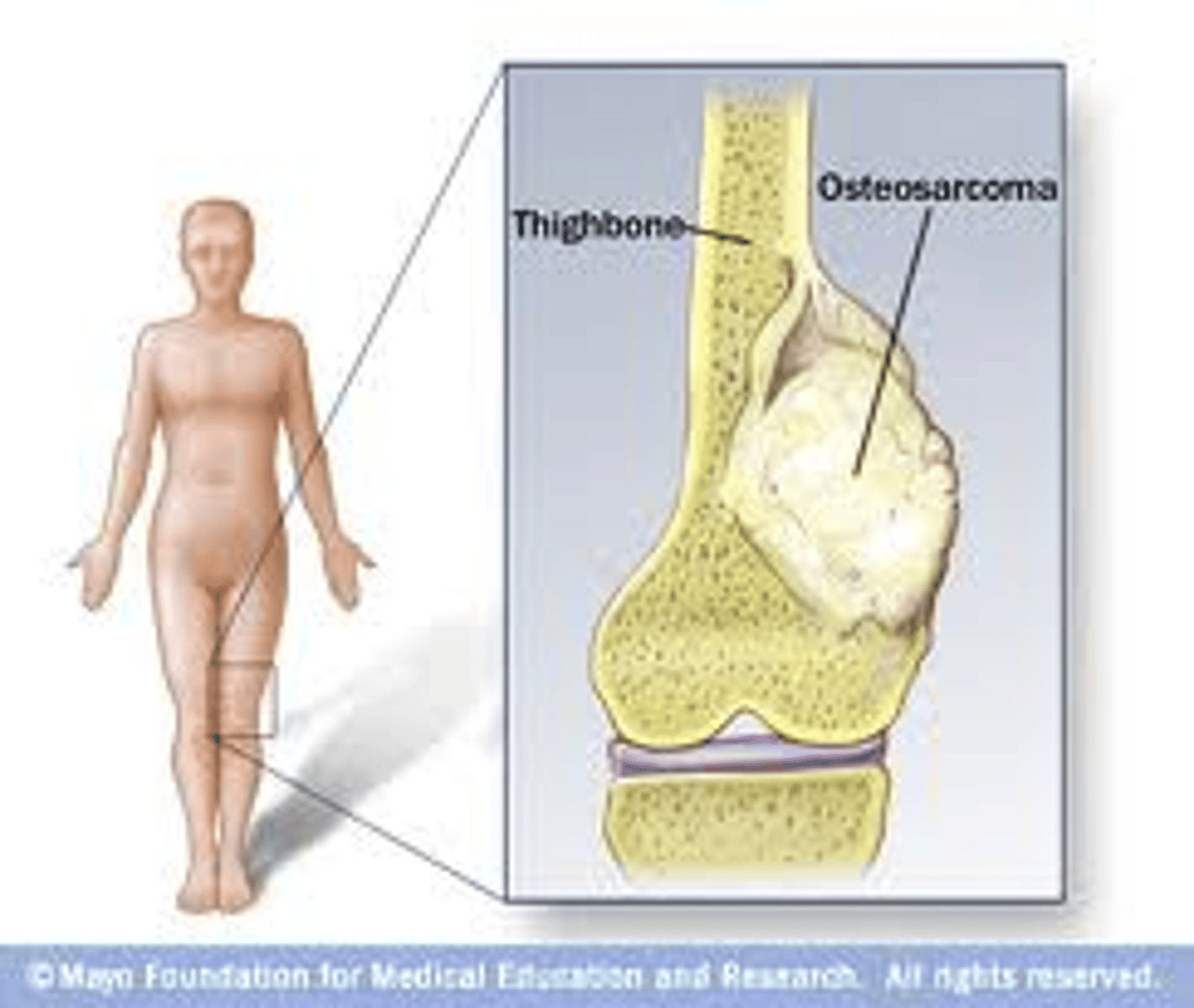 <p>common malignant tumor arising from osteoblasts, found primarily in children and adolescents</p>