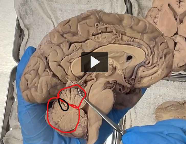 <p>anterior lobe (top red)</p><p>Primary fissure circled in black.</p><p>posterior lobe (bottom red)</p>