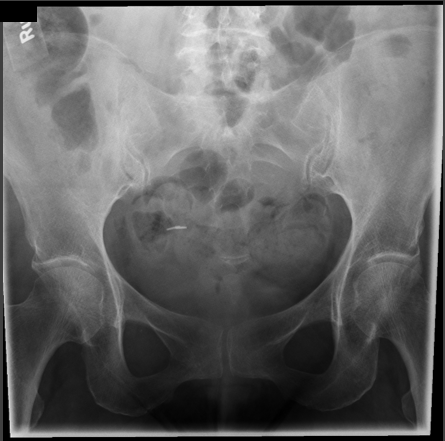 <p>critique sacrum AP axial </p>