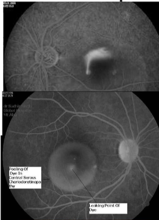 <ul><li><p>Symptoms</p><ul><li><p>Decreased, blurred vision</p></li><li><p>Metamorphopsia</p></li><li><p>Central defect in the visual field</p></li><li><p>Colours appears washed-out</p></li></ul></li><li><p>Clinical signs</p><ul><li><p>Usually unilateral sometimes bilat</p></li><li><p>Localised elevation of the retina in the macular region</p></li><li><p>Focal hyperpigmentation (sign of previous episodes)</p></li></ul></li><li><p>Investigations</p><ul><li><p>Fluorescein angiography (“smoke- stack” , “ink-blot” leakage)</p><ul><li><p>Neovasc </p></li></ul></li></ul></li><li><p>Management</p><ul><li><p>Usually not required (most cases [~80%] recover in ~6-9months)</p></li><li><p>Laser treatment may be considered</p></li></ul></li></ul><p></p>