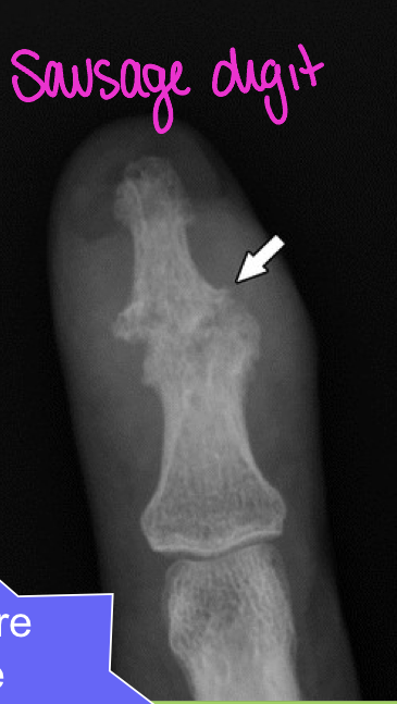<p>one joint</p><ul><li><p>i.e. erosions that shorten digits (Dactylitis/ Sausage digits) </p></li></ul><p></p>