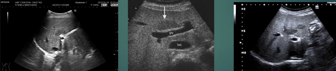 <p>Porta hepatis classic location</p>