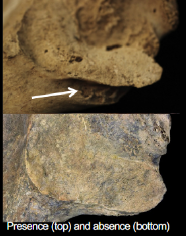 <p>Preauricular sulcus - Pelvis </p>