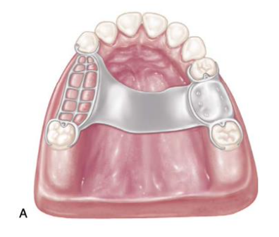 <p>Single palatal strap</p>
