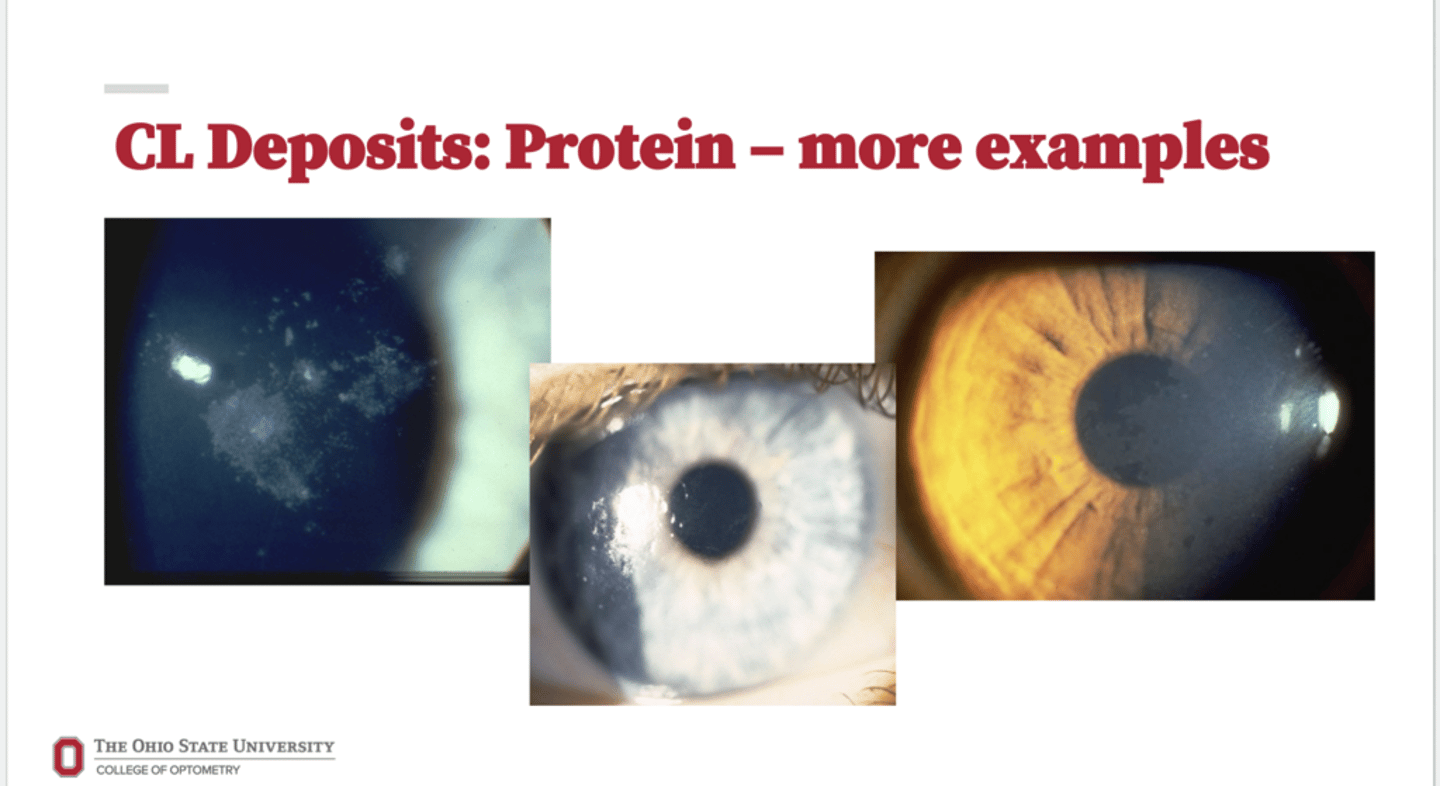 <p>CL Protein Deposits (Pic)</p>
