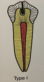 <p>“dens in dente” type I</p>