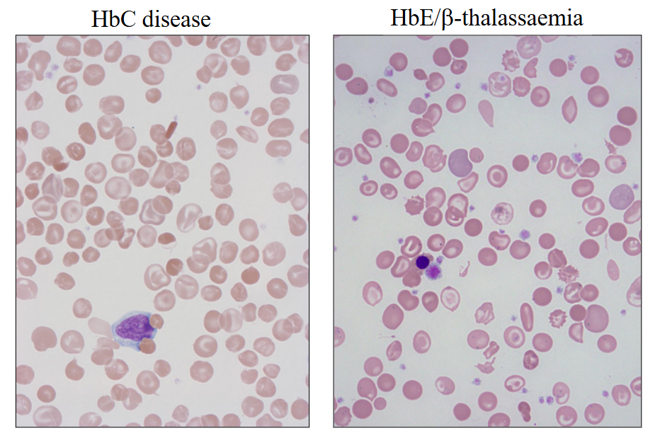 <ul><li><p>HbC disease</p></li><li><p>HbE/beta-thalassaemia</p></li></ul><p></p>