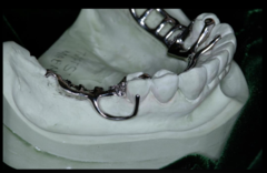 <p>Define the following:</p><p>A clasp retainer whose body extends from a major connector or denture base, passing adjacent to the soft tissue and approaching the tooth from a gingiva-occlusal direction</p>