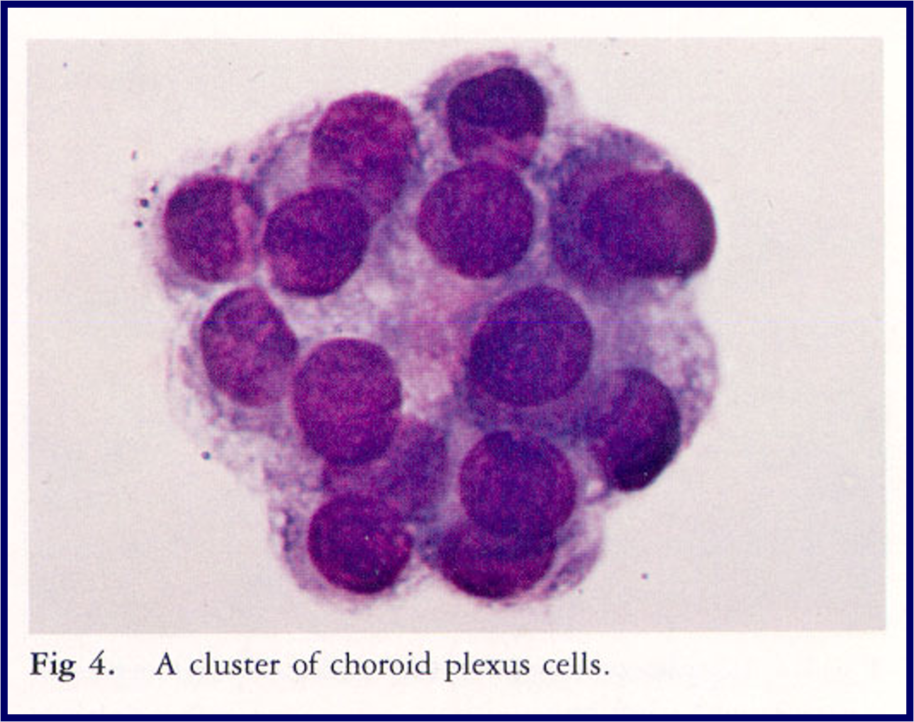 <ul><li><p>Also called choroid plexus cells line the ventricles &amp; stain as uniform, lymphocyte-like cells with abundant gray-blue cytoplasm (found in clusters)</p></li><li><p>are associated with trauma, surgery, encephalography &amp; ischemic infarct in CNS</p></li></ul><p></p>