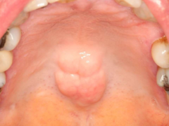 <p>ID the anatomic variant:</p>