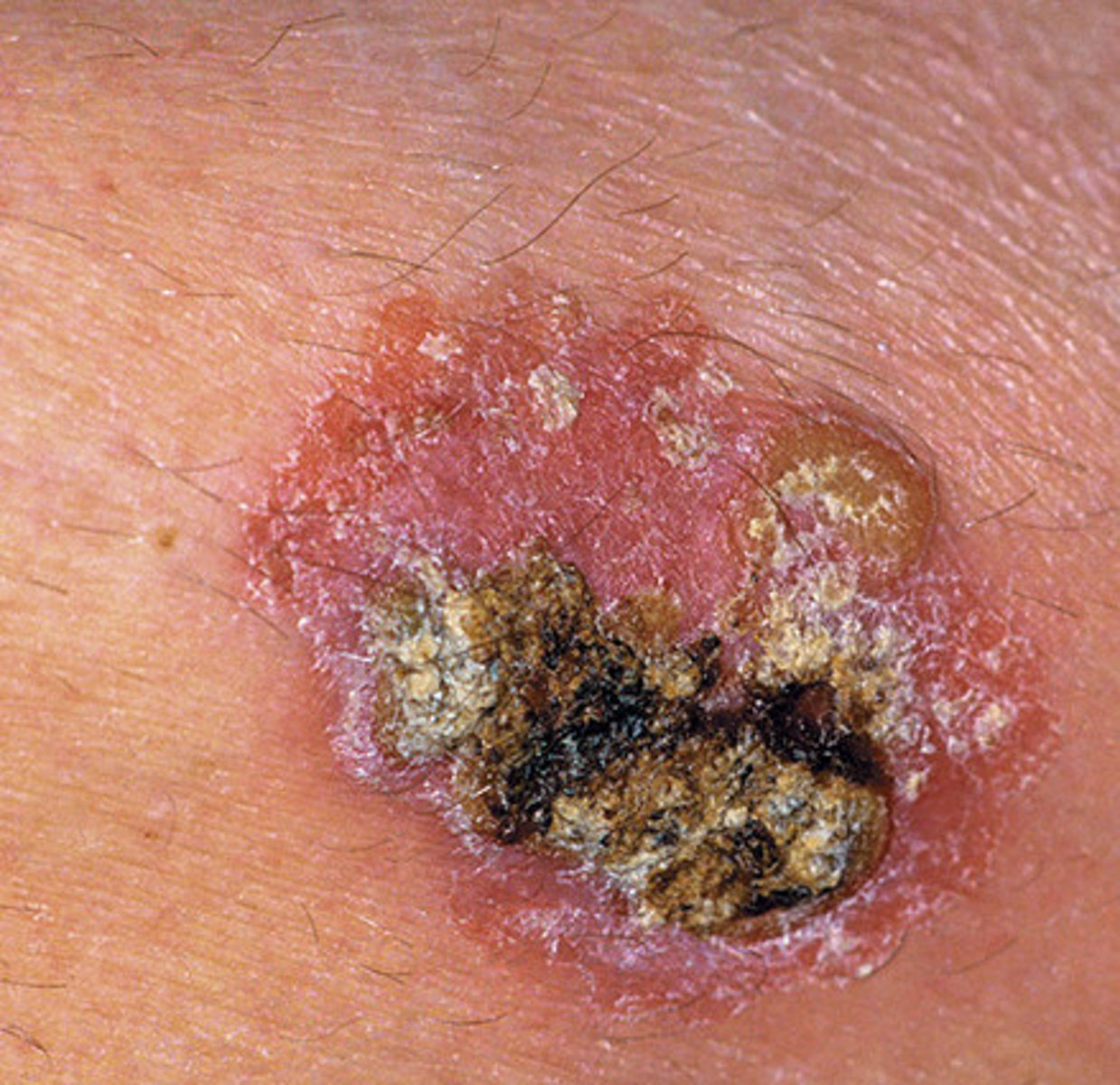 <p>It is more serious than basal cell carcinoma, characterize by scaly red papules or nodules.</p>