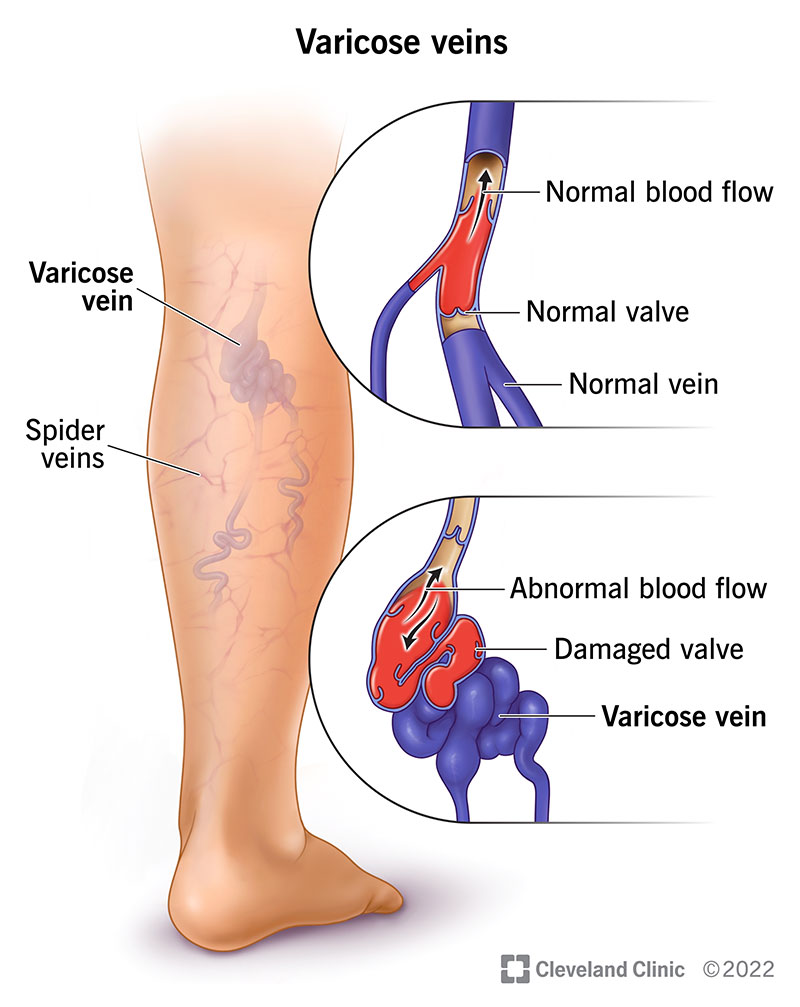 <p><strong>weak venous valves</strong> → blood flow not good from increased <strong>pressure</strong> → veins swollen from <strong>blood pooling</strong> → <strong>backflow</strong> into lower extremities</p><p>etiology:</p><ul><li><p>weak valves, increased pressure, family history</p></li></ul><p>treatment:</p><ul><li><p>surgical removal, techniques to close off affected veins</p></li></ul><p></p>