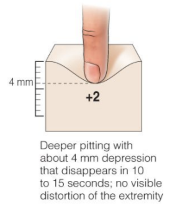 <p>4 mm</p><p>Deeper pitting that disappears in 10-15 seconds</p>