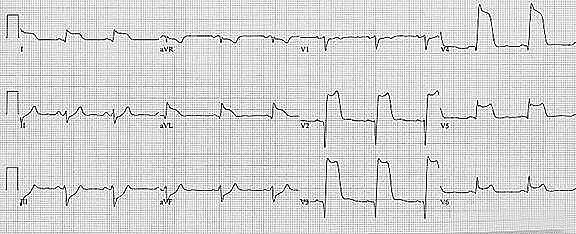 <p>howd yk this was an ant wall MI injury</p>