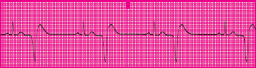 <p>Which rhythm is this?</p>